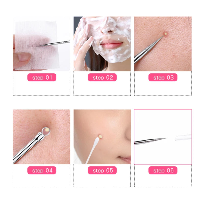 1 Pcs Blackhead Comedone Acne Pimple Blemish Extractor Remover Stainless Steel Needles Remove Tools Face Skin Care Pore Cleaner Viralgem Store
