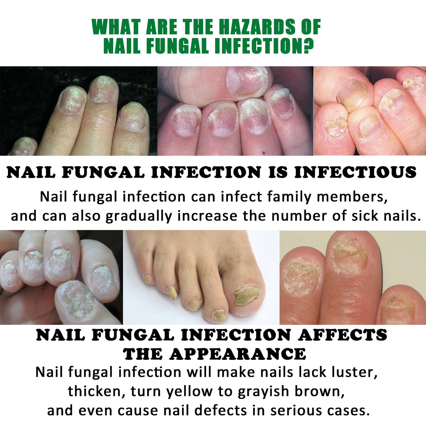 1-5Pcs Nail Fungal Treatment Device 7 Days Repair Oil Foot Toe Essence Anti Infection Paronychia Ginger Onychomycosis Gel Care