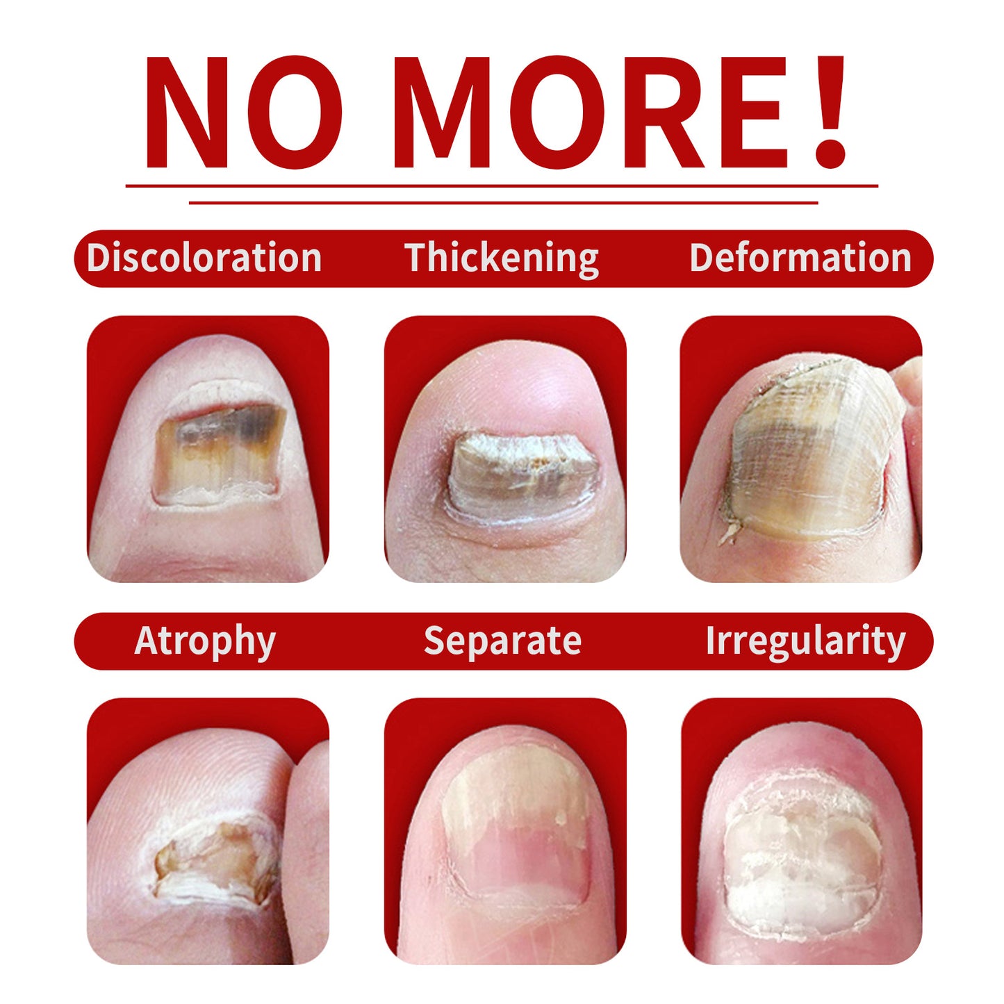 1-5Pcs Nail Fungal Treatment Device 7 Days Repair Oil Foot Toe Essence Anti Infection Paronychia Ginger Onychomycosis Gel Care