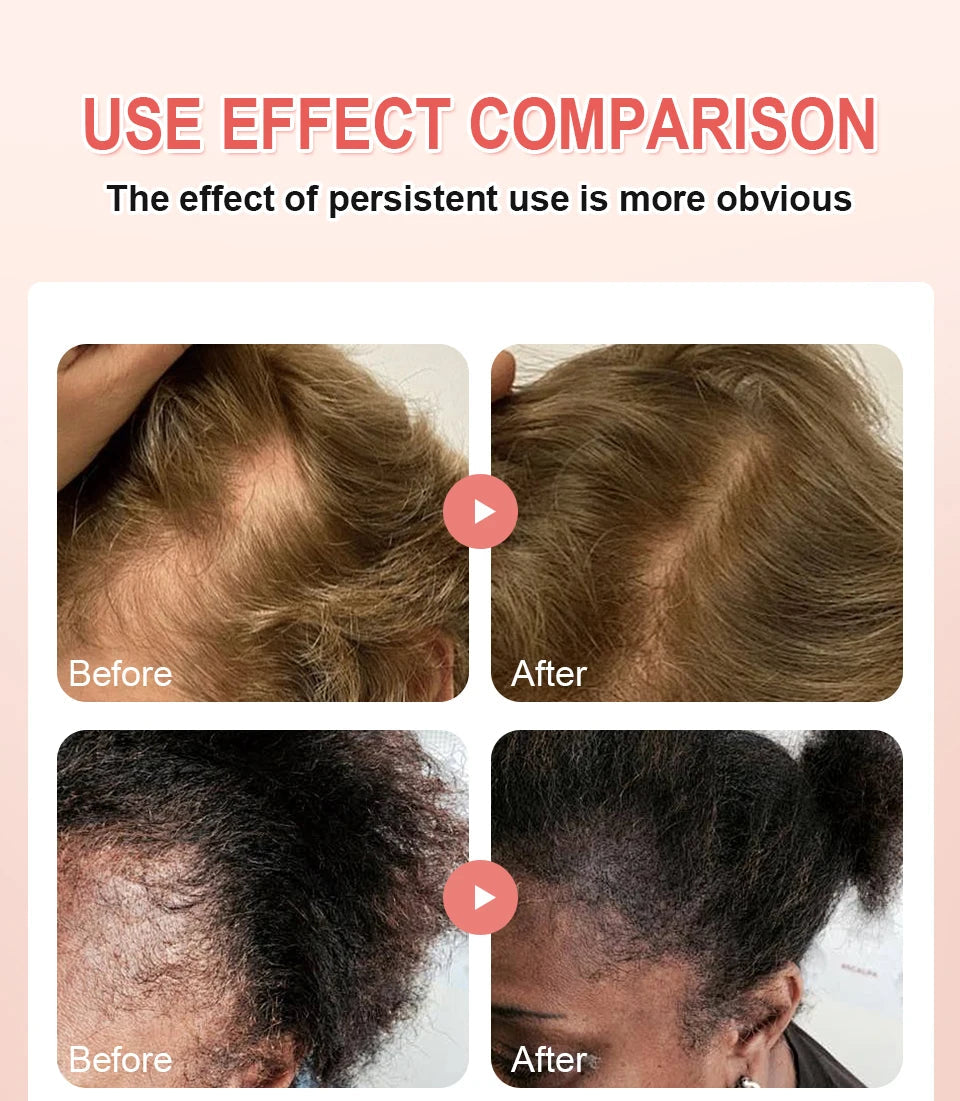 Super 5x Fenugreek Anti-Hair Loss Oil For Man Hair Treatment Fast Regrowth Thicken Oils Scalp Damaged  Repair Care Products Viralgem Store