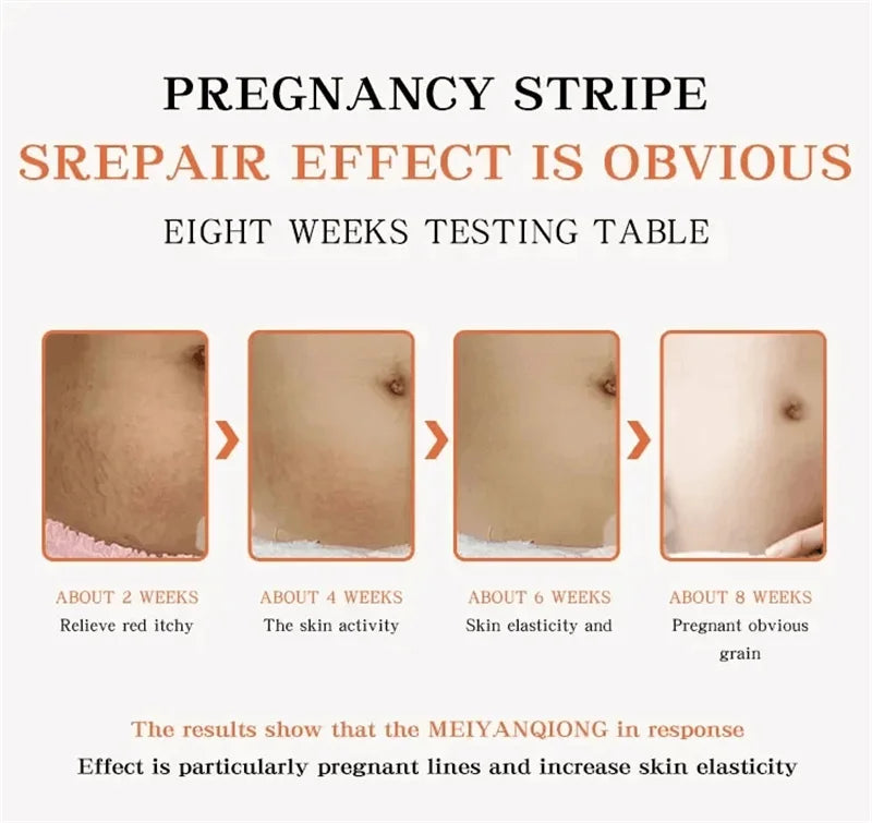 Stretch Marks Permanent Removal Cream Maternity Pregnant Women Pregnancy Anti-Winkle Smooth Repair Firming Skin Body Skin Care