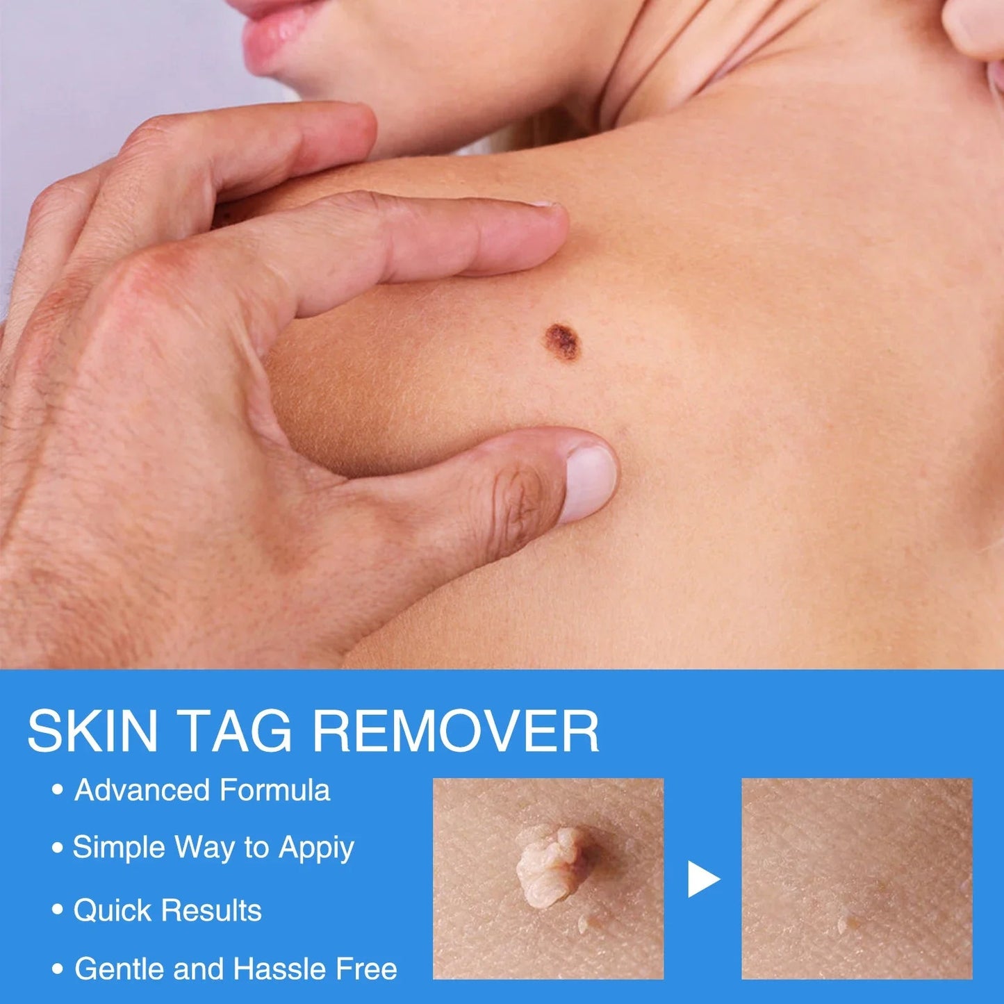 2 IN 1 Auto Micro Skin Tag Remover Device Standard And Micro Skin Tag Removal Kit Adult Mole Wart Remover Face Care Beauty Tools Viralgem Store