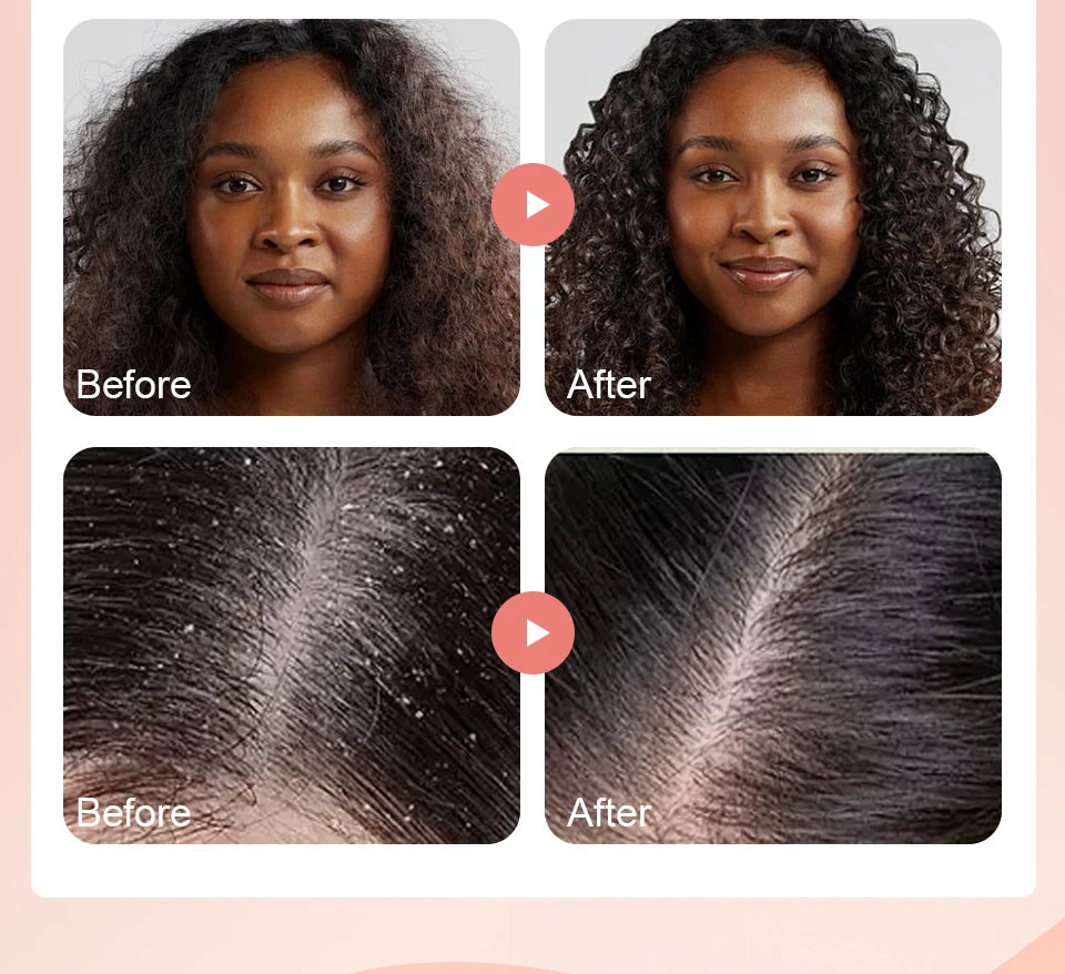 Super 5x Fenugreek Anti-Hair Loss Oil For Man Hair Treatment Fast Regrowth Thicken Oils Scalp Damaged  Repair Care Products Viralgem Store