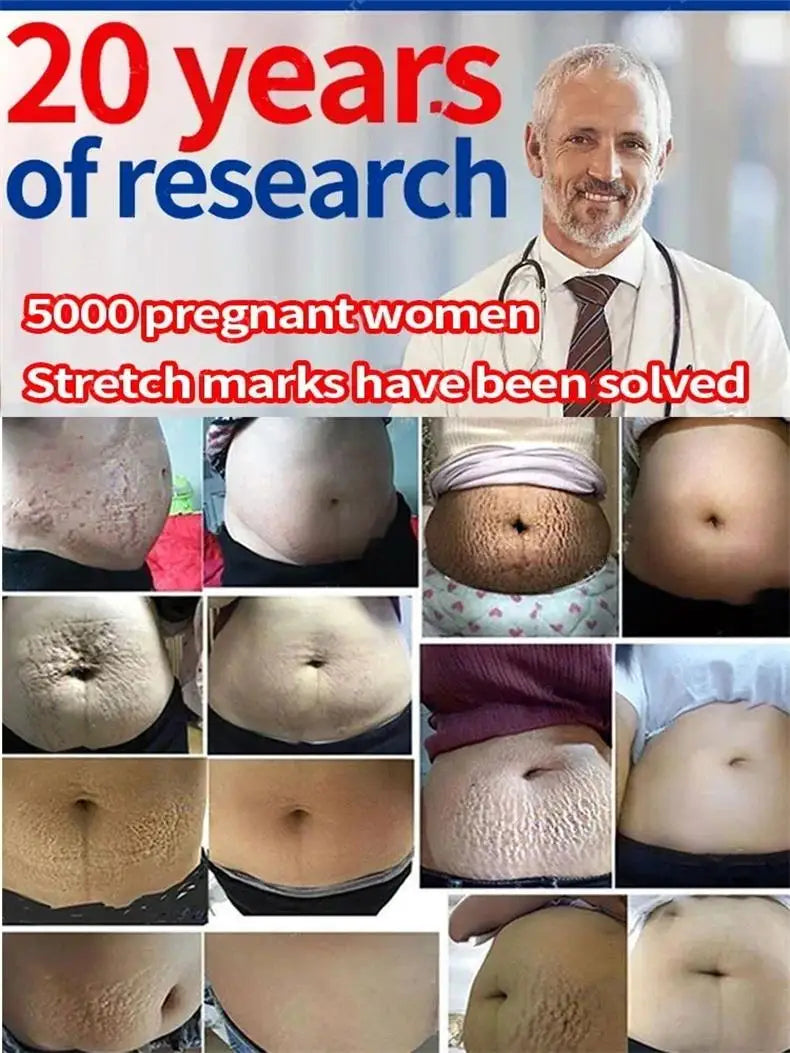 Stretch Marks Permanent Removal Cream Eliminate Body Belly Stretch Marks Swelling Marks Remove Skin Cracks Repair Firming Care Viralgem Store