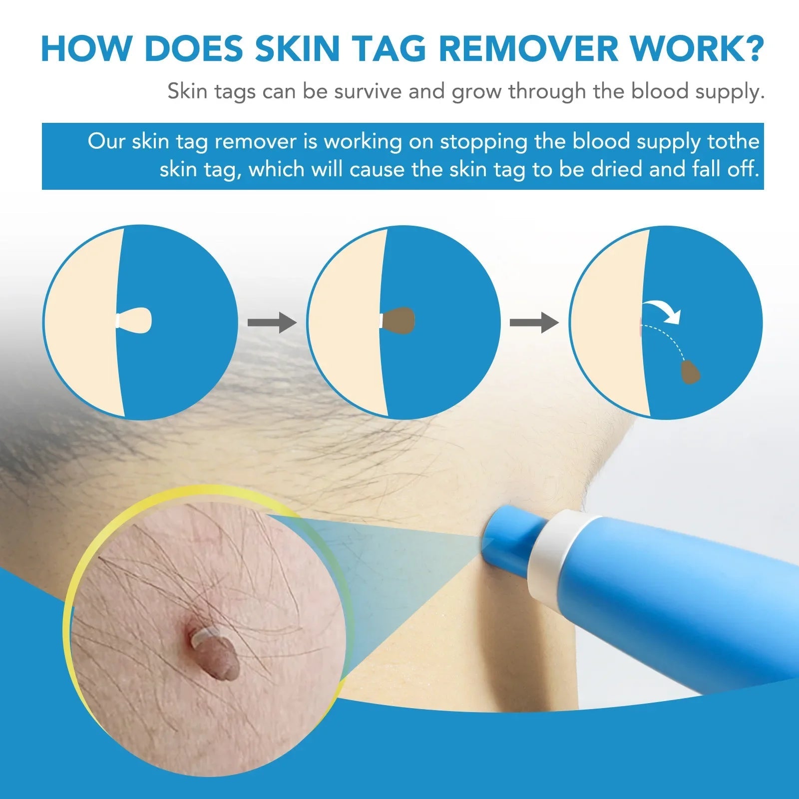2 IN 1 Auto Micro Skin Tag Remover Device Standard And Micro Skin Tag Removal Kit Adult Mole Wart Remover Face Care Beauty Tools Viralgem Store