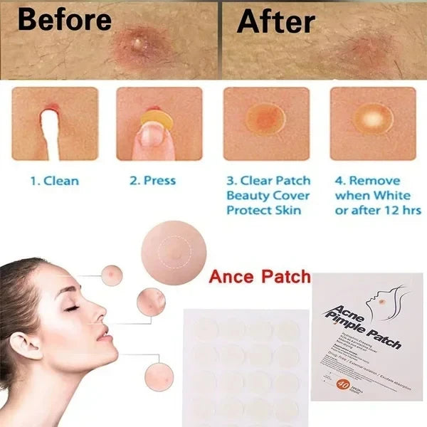 24pcs Face Acne Pimple Spot Facial Skin Care Blackhead Removal Freckle Patches Scar Care Treatment Stickers Acne Mask Beauty Viralgem Store