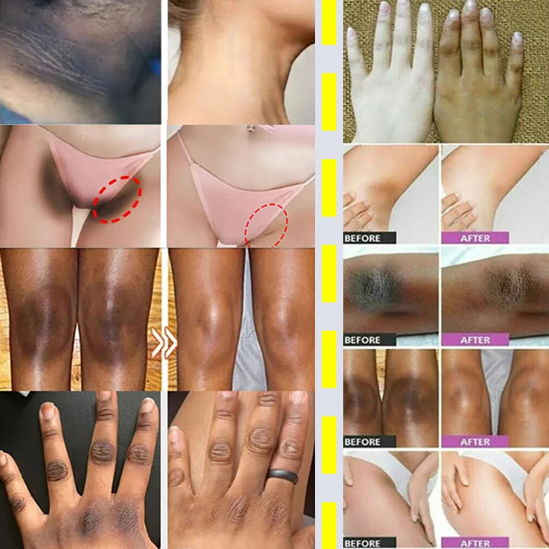 Whitening Cream Private Parts Underarm Bleaching Serum Whiten Butt Knee Brighten Inner Thigh Intimate Parts Dark Remove Melanin Viralgem Store