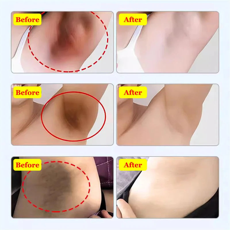 Whitening Cream Private Parts Underarm Bleaching Serum Whiten Butt Knee Brighten Inner Thigh Intimate Parts Dark Remove Melanin Viralgem Store