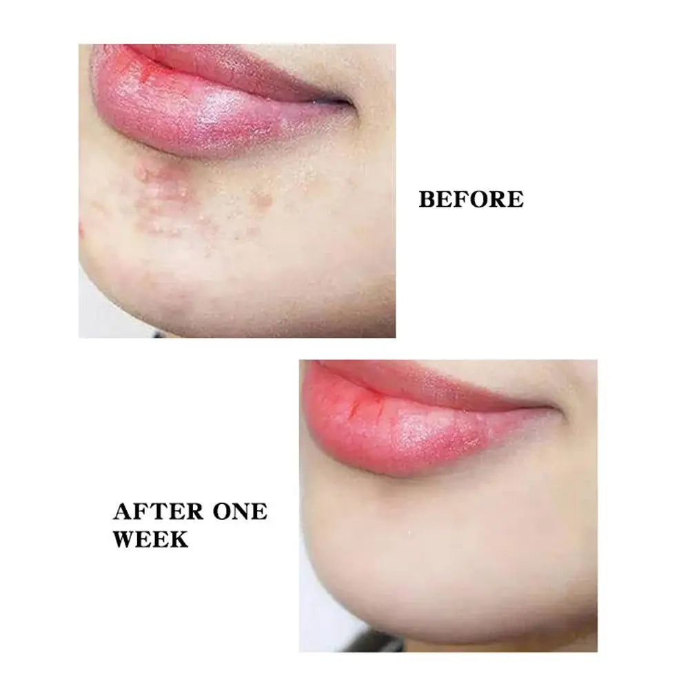 300/600pcs Invisible Acne Patch Reduce Pimples Blackheads Mild Non-irritating Concealer Face Spot Skin Care Tools Waterproof