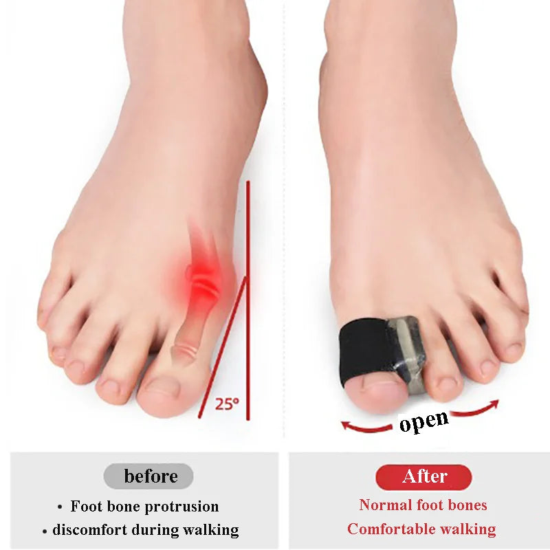 1/2/4Pc TwoToe Separator Hallux Valgus Bunion Corrector Orthotics Feet Bone Thumb Adjuster Correction Pedicure Feet Straightener