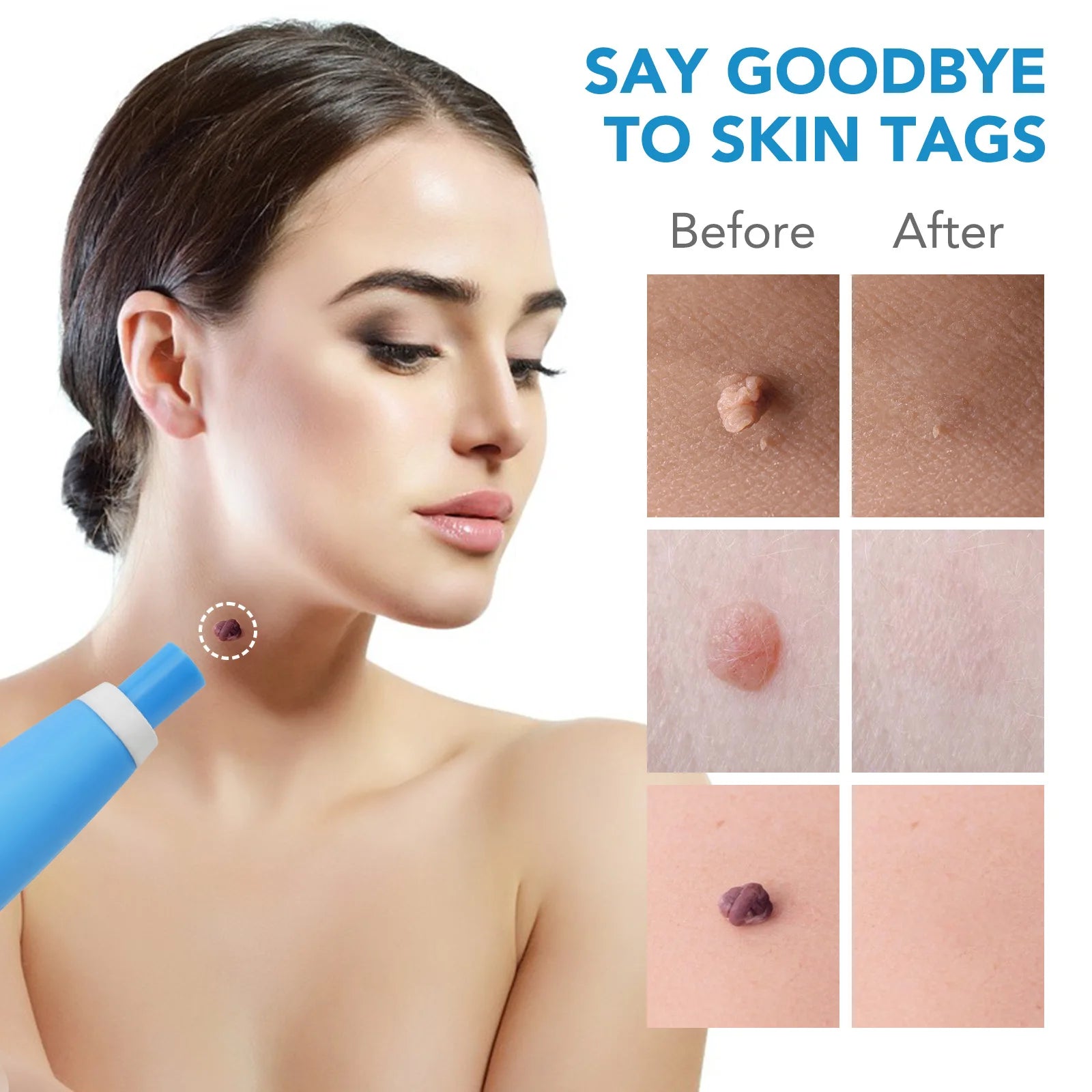 2 IN 1 Auto Micro Skin Tag Remover Device Standard And Micro Skin Tag Removal Kit Adult Mole Wart Remover Face Care Beauty Tools Viralgem Store