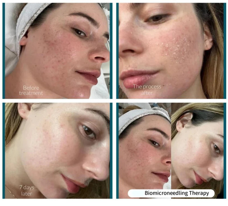 10pcs Sponge Microcrystal Freeze-dried Powder Collagen Regeneration Natural Biological Extract Sponge Spicules Skin Cell Renew Viralgem Store