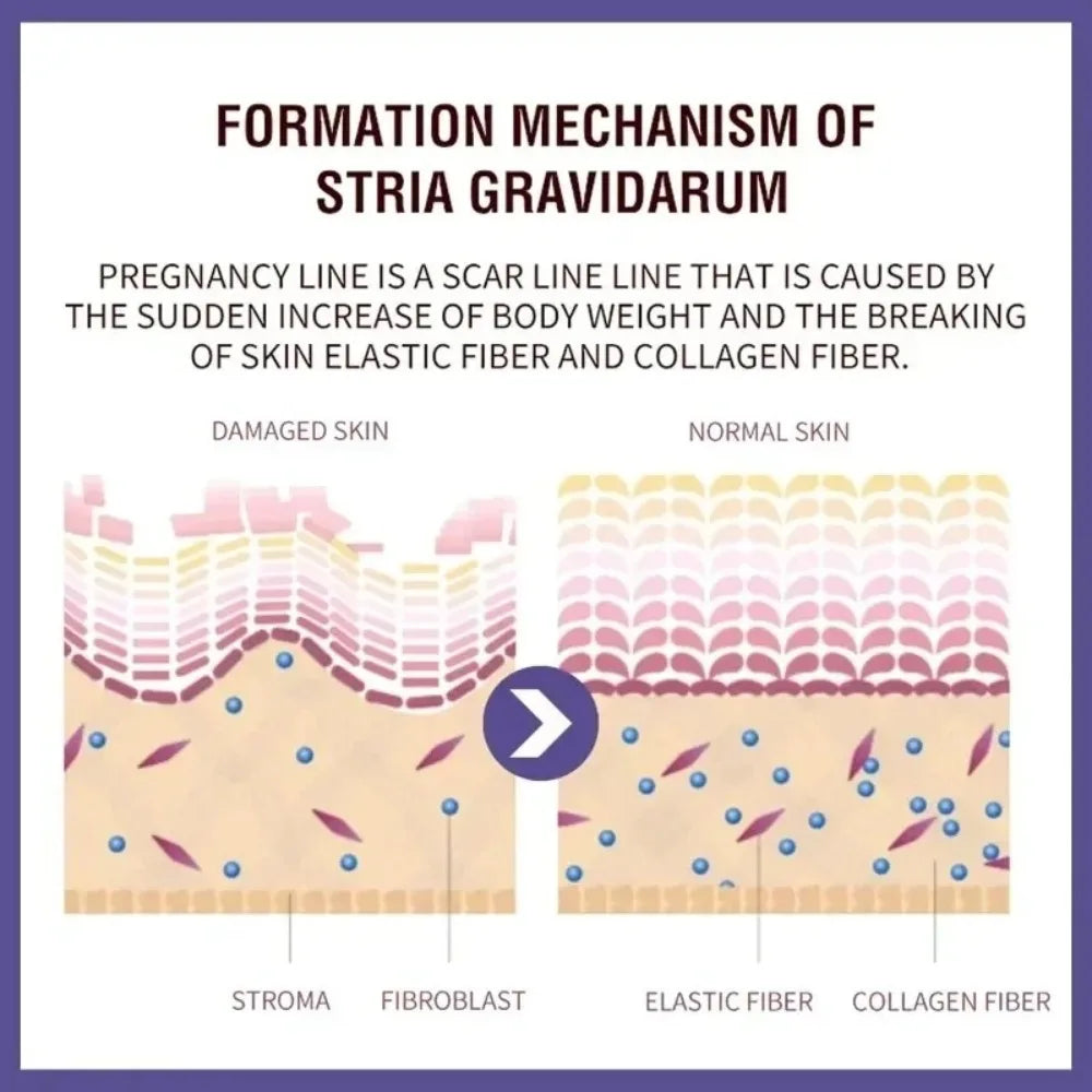 Stretch Marks Permanent Removal Cream Eliminate Body Belly Stretch Marks Swelling Marks Remove Skin Cracks Repair Firming Care Viralgem Store