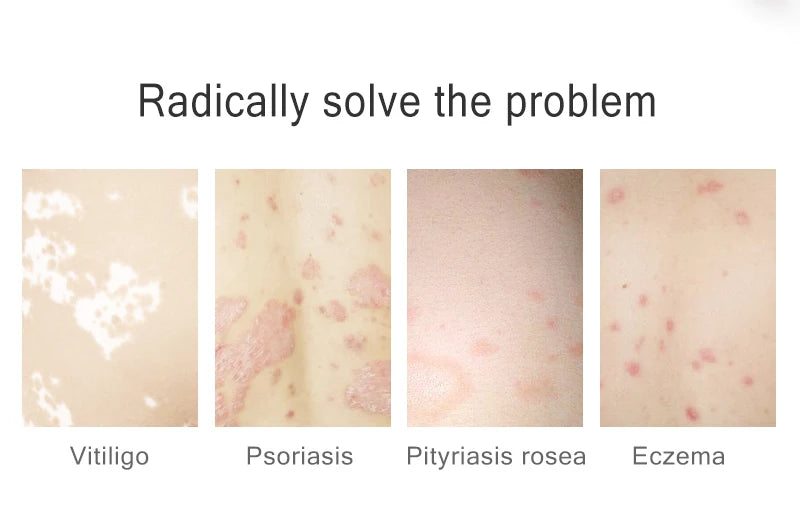 UV 311nm Ultraviolet Phototherapy Device Uses UVB Lamp To Treat Vitiligo, Psoriasis, White Spots And Skin Diseases