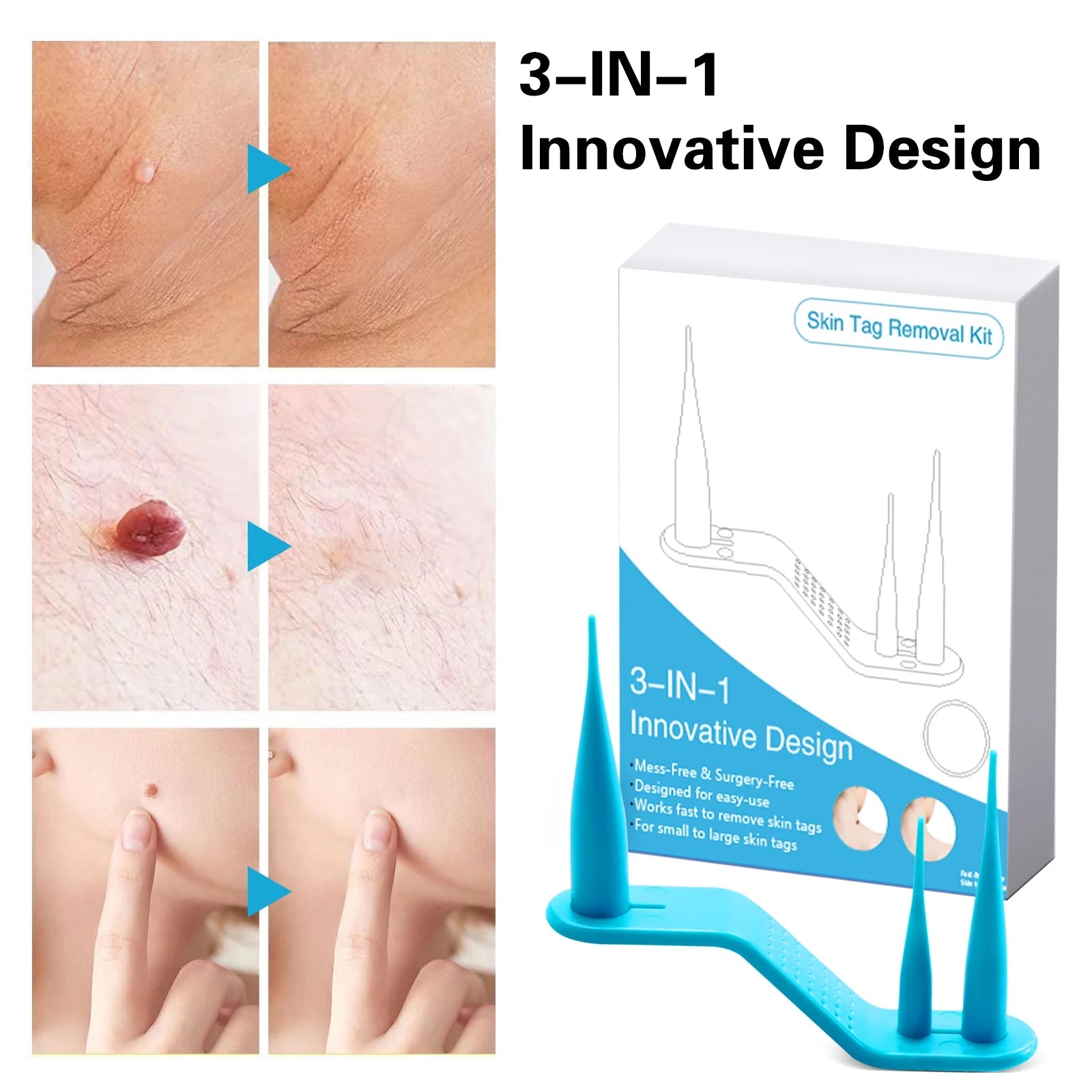 2 IN 1 Auto Micro Skin Tag Remover Device Standard And Micro Skin Tag Removal Kit Adult Mole Wart Remover Face Care Beauty Tools Viralgem Store