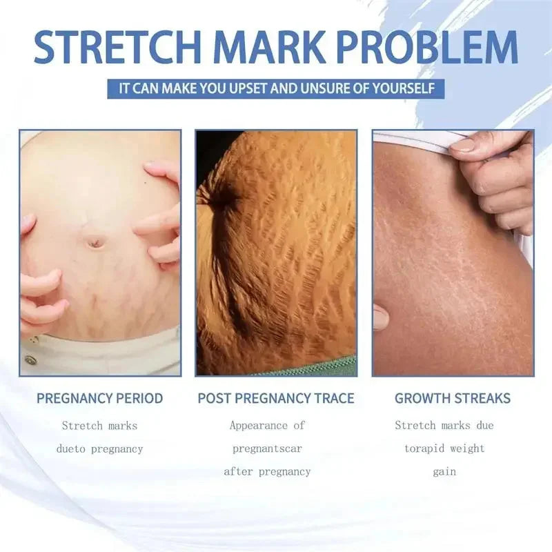 Stretch Marks Permanent Removal Cream Eliminate Body Belly Stretch Marks Swelling Marks Remove Skin Cracks Repair Firming Care Viralgem Store