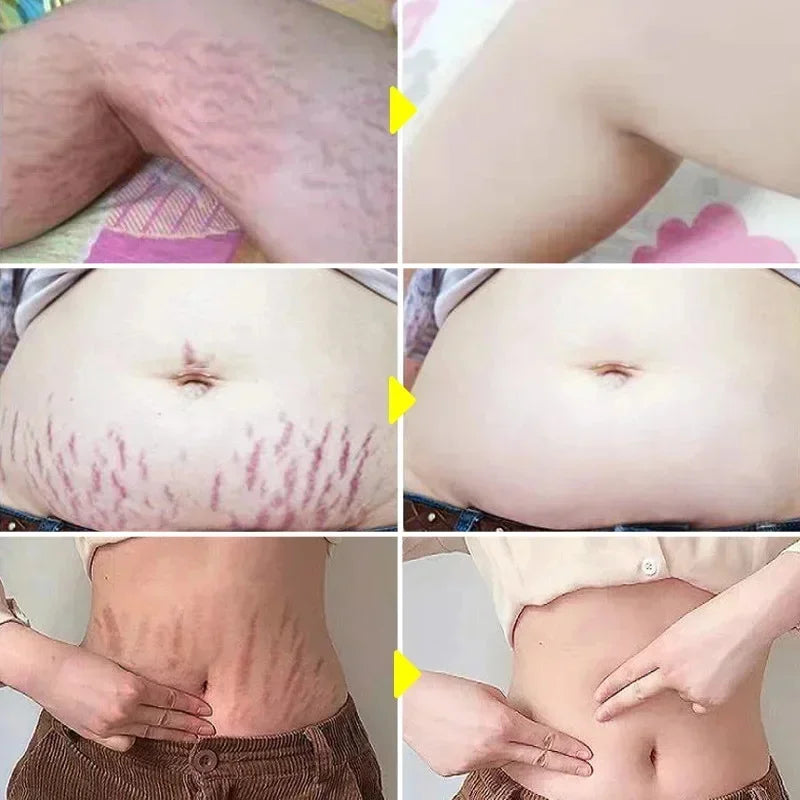 Stretch Marks Permanent Removal Cream Eliminate Body Belly Stretch Marks Swelling Marks Remove Skin Cracks Repair Firming Care Viralgem Store