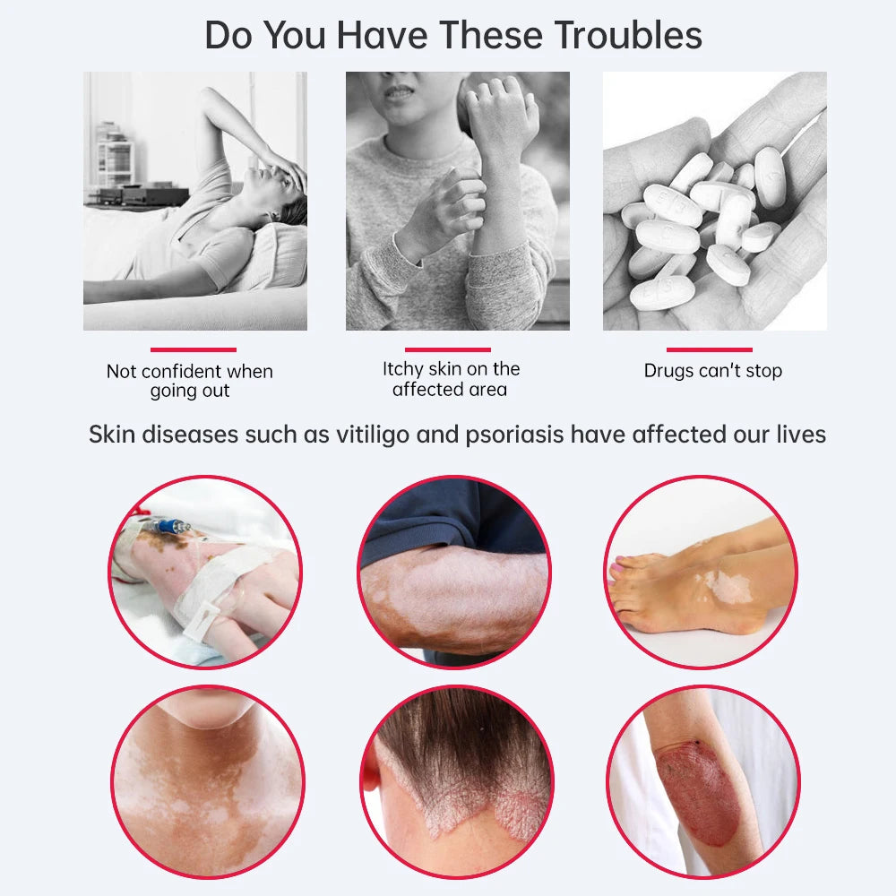 UV 311nm Ultraviolet Phototherapy Device Uses UVB Lamp To Treat Vitiligo, Psoriasis, White Spots And Skin Diseases