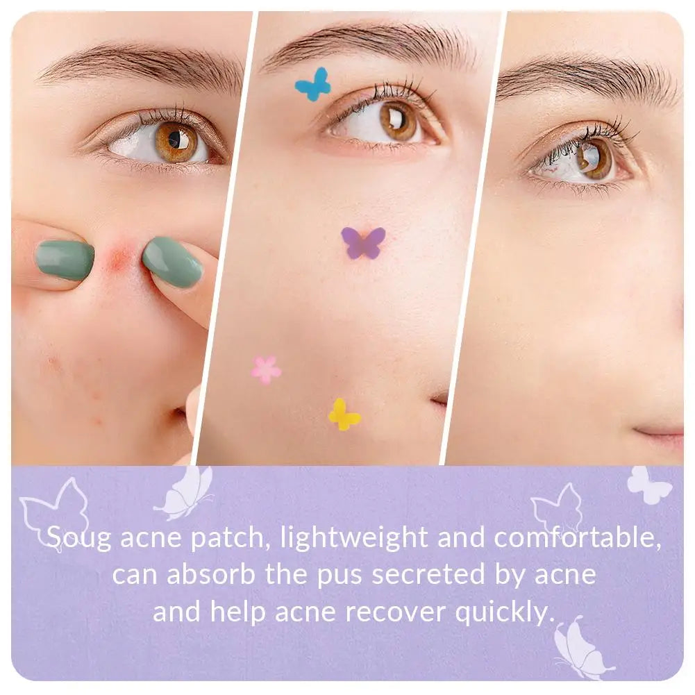 120Pcs Butterfly Shape Acne Pimple Patch Stickers Blemish Spot Concealer Cover 0.1mm Acne Treatment Pimple Remover Skin Care Viralgem Store