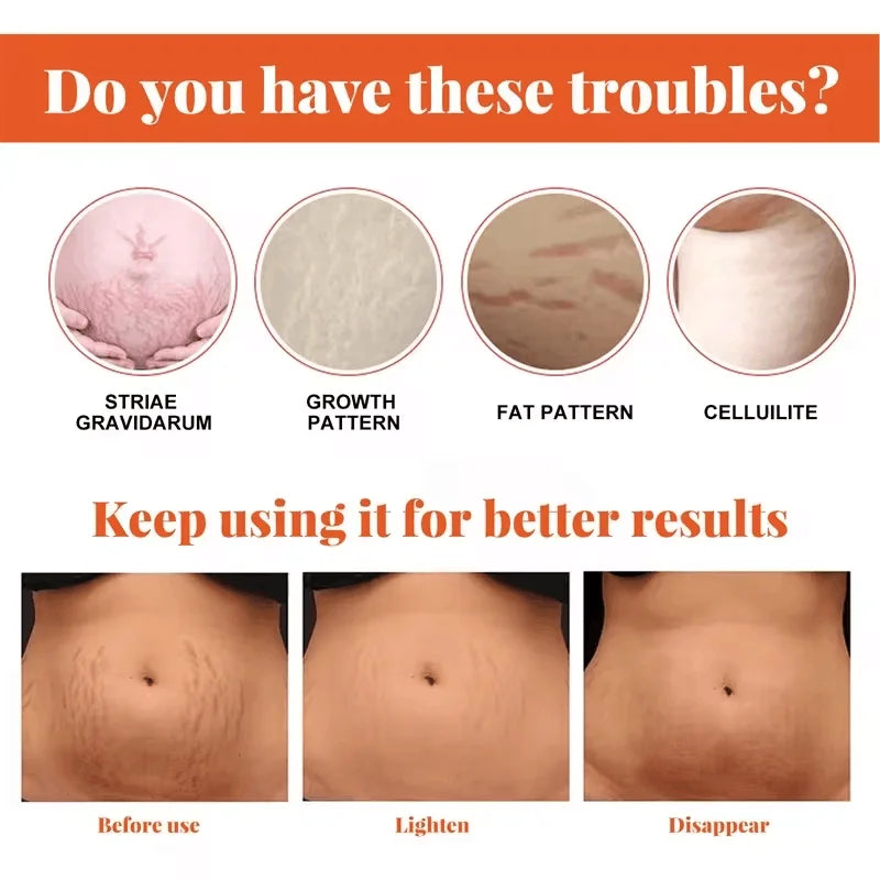 Stretch Marks Permanent Removal Cream Maternity Pregnant Women Pregnancy Anti-Winkle Smooth Repair Firming Skin Body Skin Care