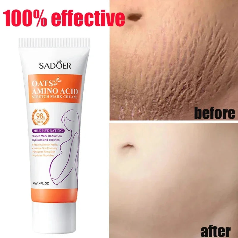 Stretch Marks Permanent Removal Cream Eliminate Body Belly Stretch Marks Swelling Marks Remove Skin Cracks Repair Firming Care Viralgem Store