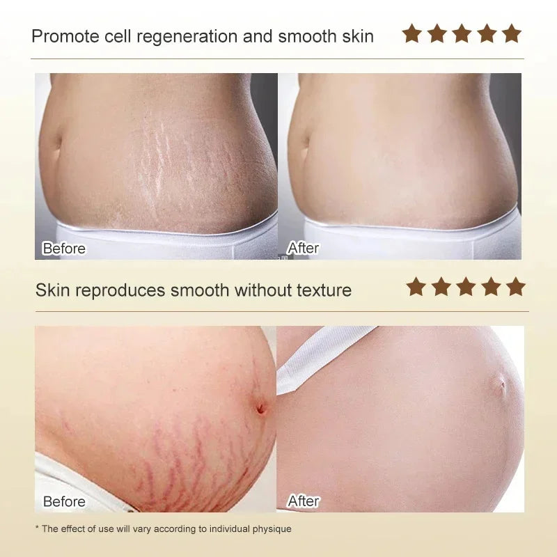 Stretch Marks Permanent Removal Cream Eliminate Body Belly Stretch Marks Swelling Marks Remove Skin Cracks Repair Firming Care Viralgem Store