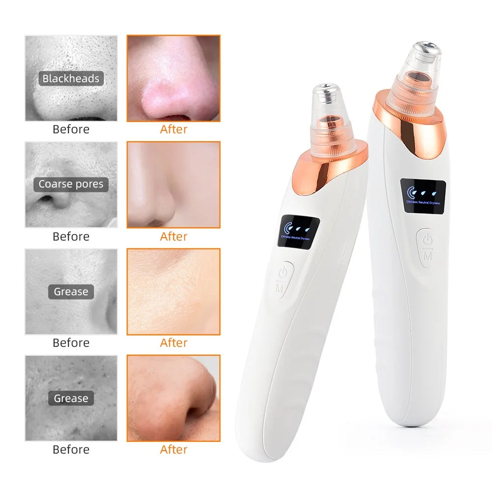 Vacuum Nose Blackhead Remover Face Cleansing Beauty Machine Facial Suction Cleaner Pimple Dead Skin Remover Extractor Skin Care Viralgem Store