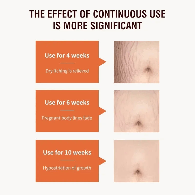 Stretch Marks Permanent Removal Cream Maternity Pregnant Women Pregnancy Anti-Winkle Smooth Repair Firming Skin Body Skin Care