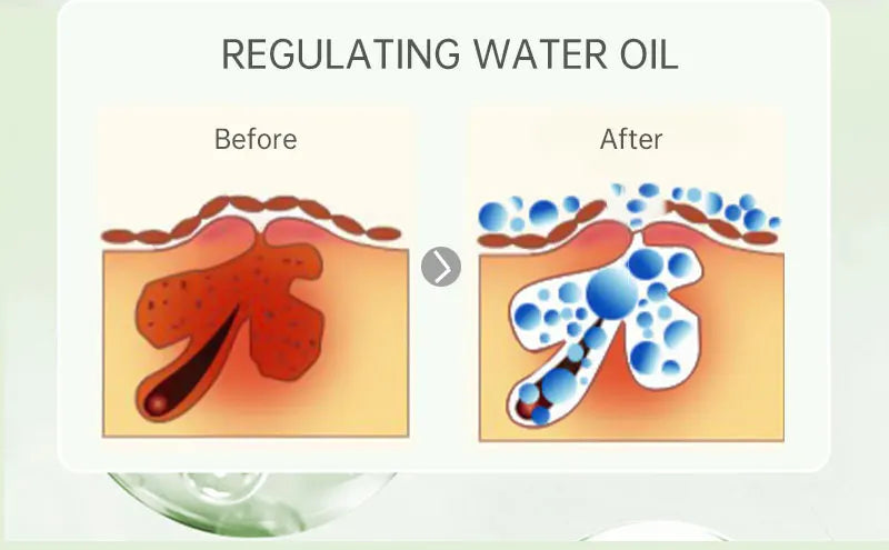 Tea Tree Acne Treatment Facial Serum Moisturizing Hyaluronic Acid Oil Control Pimple Removal Essence Face Serum Skin Care