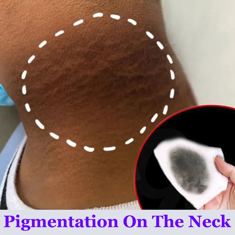 Whitening Cream Private Parts Underarm Bleaching Serum Whiten Butt Knee Brighten Inner Thigh Intimate Parts Dark Remove Melanin Viralgem Store