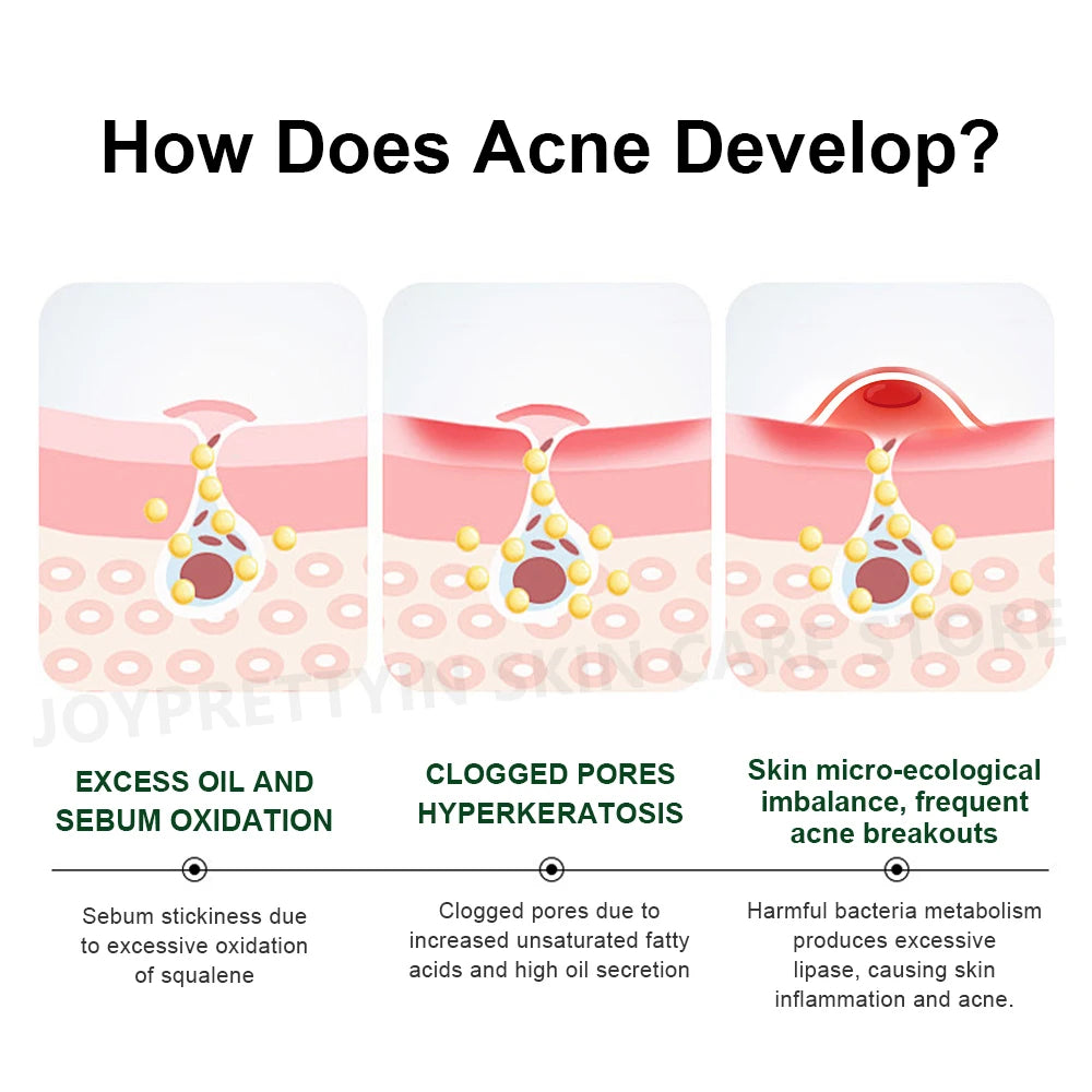 Tea Tree Acne Treatment Facial Serum Moisturizing Hyaluronic Acid Oil Control Pimple Removal Essence Face Serum Skin Care